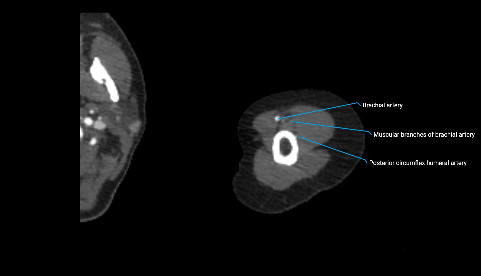 CTA upper limb axial cross sectional anatomy labelled image 282 (2).webp